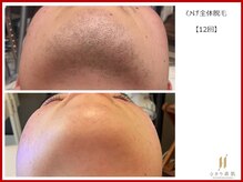 ひかり素肌/ひげ脱毛12回