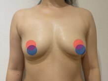 ポインセチア(Poinsettia)/施術回数3回の効果/重ね比較