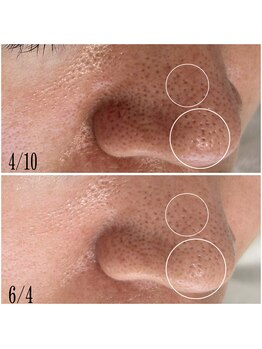 プラセル(Placer)/深い開きもおまかせください☆