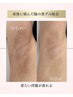 【70%オフ残り4名様】ローマピンク/ワキの黒ずみ ¥440,000→¥132,000