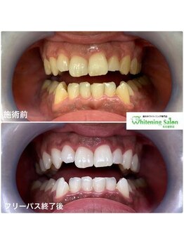 ホワイトニングサロン 名古屋駅店/【ホワイトニング施術例】