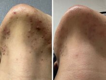 ロカスウィッチ(roca switch)/よもぎ蒸しで脱ブツブツ