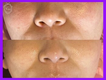 ヴィオール 名古屋栄店(VIOR)/光Vショット施術 ほうれい線