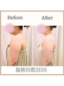 サロンルーチェ(Salon Luce)/20代ビフォーアフター/施術12回