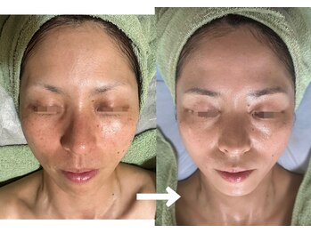 ルーチェ(LUCE)/グリーンピール5DAYS