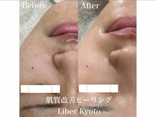 エステティック リベル キョウト 京都駅前店(Esthetic Liber Kyoto)/肌質改善ピーリング