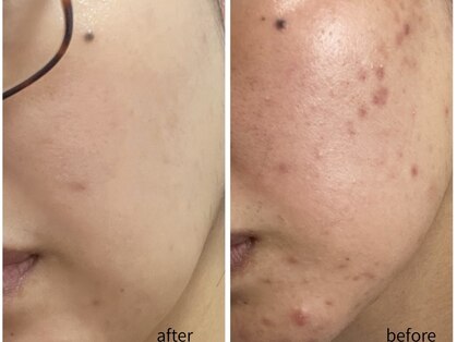 beauty salon LALA 大阪南森町｜ハーブピーリング・肌質改善・インディバの写真