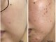 beauty salon LALA 大阪南森町｜ハーブピーリング・肌質改善・インディバの写真