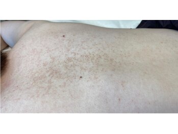 リベル 名古屋(Lebelle:)/ハーブピーリング専門名古屋