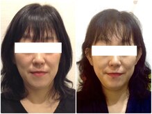 ウェリナ平和堂長久手院/.【小顔矯正before→after】