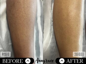 アングレイス(Anngrace)/【全身脱毛あし】Before/After