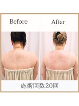 サロンルーチェ(Salon Luce)/20代ビフォーアフター/施術12回