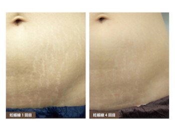 たるみ子さんと小顔くん/サーモシェイプ身体