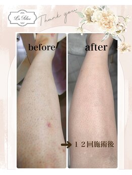 ラ フェリーチェ(La Felice)/ひざ下脱毛before after