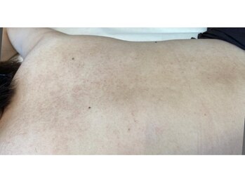 リベル 名古屋(Lebelle:)/ハーブピーリング専門名古屋