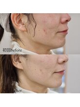 サロン アイミー(salon i me)/テラボーラー症例