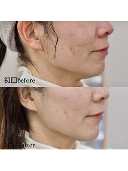 サロン アイミー(salon i me)/テラボーラー症例