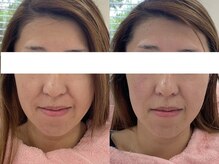 サクラ 本厚木駅前店(SAKURA)/本厚木/シミ/しみ/たるみ