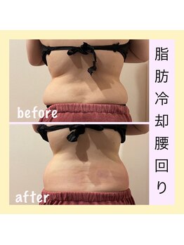 アールアンドエス(R&S)/脂肪冷却