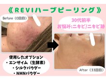 ウル 下北沢(Ulu)の雰囲気（お肌は何歳からでも変われます！#REVI #ハーブピーリング#下北沢）