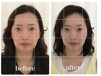 アキュモンド 渋谷院(acumond)/クイック美顔鍼コース3回の変化