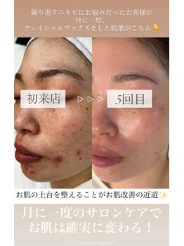 エリス(ELISSE)/サロンケアでお肌劇的変化