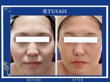 ビテュセスリー はなみずき店(美tusais3)/【小顔・小顔矯正】小顔コルギ