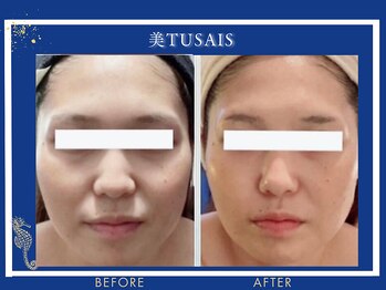 ビテュセスリー はなみずき店(美tusais3)/【小顔・小顔矯正】小顔コルギ