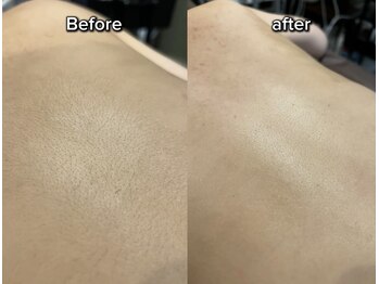美意識の写真/敏感肌も美肌になるお肌に優しい全身脱毛！背中産毛、乳輪内も脱毛効果◎ツルツル肌へ！全身隅々まで脱毛可