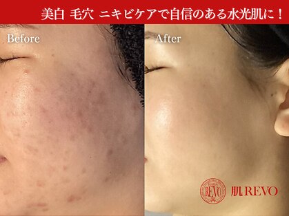 肌レボ 高田馬場店(肌REVO)の写真