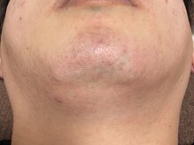 アトリウムオム 博多(ATRIUM HOMME)/ヒゲ脱毛８回目施術後