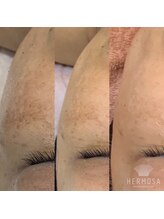 メリア(Mellia)/角育ハーブトリートメント