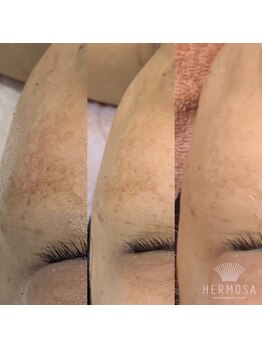 メリア(Mellia)/角育ハーブトリートメント