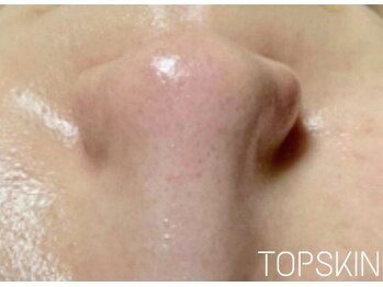 トップスキン 名駅(TOPSKIN)/頑固な黒ずみ毛穴の撃退!
