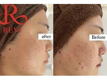 ホワイトアクア 中目黒店(WHITE AQUA)/ハーブピーリング/ニキビ/中目黒