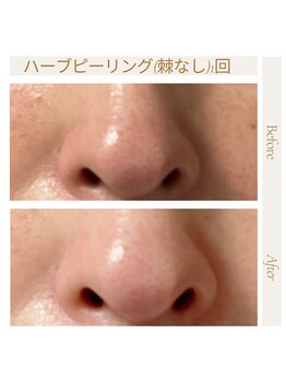 アトワ(A toi)/ハーブピーリング ソフトタイプ