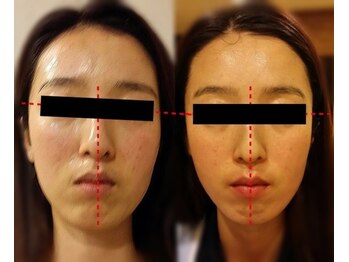 ケイビューティーサロン(K BeautySalon)/小顔リガメント(顔靱帯)コルギ