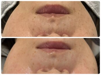 エフェクト 塚口店(effect)/Before After 40代/3回目