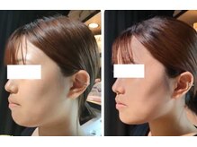 エクレクティック(ECLECTIC)の雰囲気（【話題のレモンボトル】二重顎、脂肪のたるみを最速改善！）