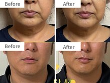 アクア(akua....)/施術1回★フェイスラインの改善