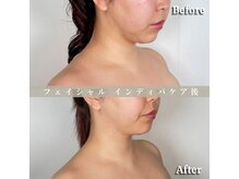 術後の女神 大阪本町店/ダウンタイムケア・インディバ