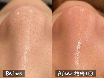 セレブリボーン 大阪ボーテ/ハイドロ毛穴洗浄