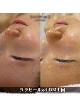 サロン ド エス アオヤマ(SALON DE S AOYAMA)/ララピール＆LDM（つるつる肌）