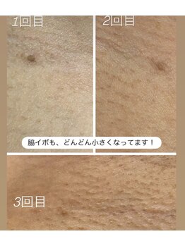 スリーピングビューティー(Sleeping Beauty)/ニキビ、赤み改善