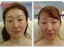 サナティオ(SANATIO)/微細針ピーリング＆毛穴洗浄