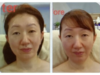 サナティオ(SANATIO)/微細針ピーリング＆毛穴洗浄