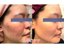 メディカルエステサロン ローズ 高岡店(ROSE)/フェイシャルビフォーアフター