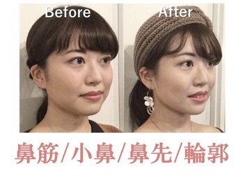 ラプリボヤージュ 藤沢店(Raplit)/ 隆鼻＋輪郭矯正40分10回コース