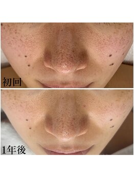 プラセル(Placer)/ホームケアもとっても大切☆