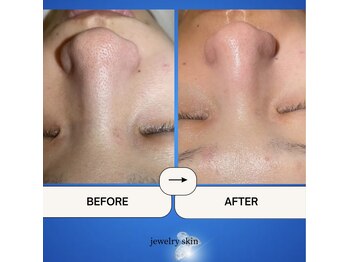 ジュエリースキン(JewelrySkin)/憧れのツルン肌へ。